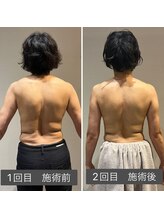 ロッタ エクリュ(Lotta ecru+)/肩甲骨筋膜リリースマッサージ