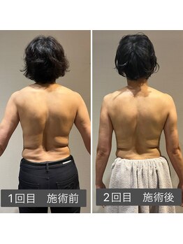 ロッタ エクリュ(Lotta ecru+)/肩甲骨筋膜リリースマッサージ