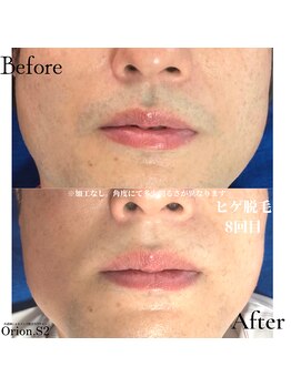 オリオンドットエスツー(Orion.S2)/【Before→After】