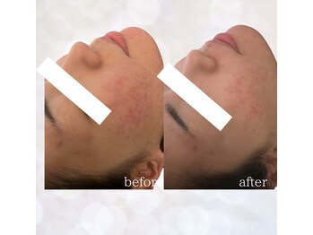 ビスイ 恵比寿(Bisui)/ハーブピーリング/ニキビケア