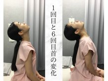 リバティ 世田谷代田整体院(Liberty)/肩甲骨はがし「首の動きアップ」