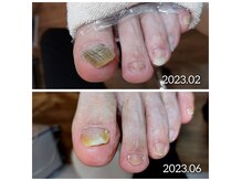 厚い！硬い！切れない！お困りの爪はすべてお任せ下さい♪