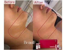 エステサロン ジョアアンジェ(joie ange)/結果を実感◎レッドショット