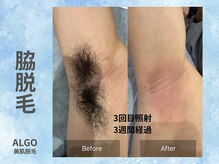 アルゴ 山口宇部店(ALGO)/即日！脇脱毛+WAX