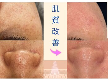 フットミー(foot mii)の写真/土台を本気改善！毛穴洗浄で、肌を育てながらクリアな毛穴へ☆毛穴やしみが気になる方◎