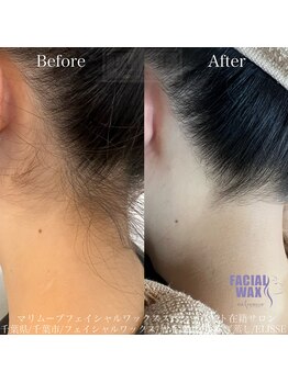 エリス(ELISSE)/うなじ脱毛でうなじ美人