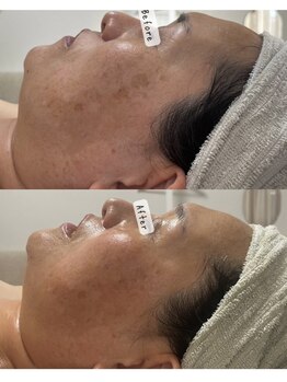 プアラ(puala)/肌育ボンバーフェイシャル