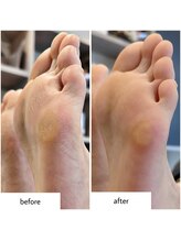 ケアプラス(care plus)/足裏角質ケア