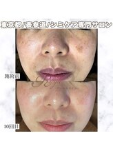 アールスタイル 表参道(R-style)/続けてシミも肌も綺麗になる◎