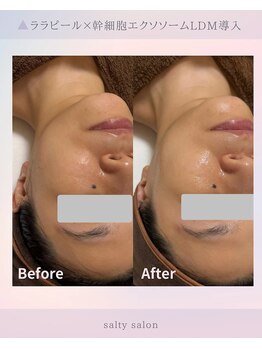 ソルティ サロン(salty salon)/ララピール×ヒアルロン酸導入