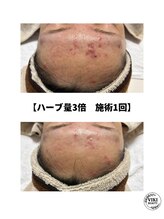 ヴィキ 北千住(VIKI)/【ハーブ量3倍　施術1回】