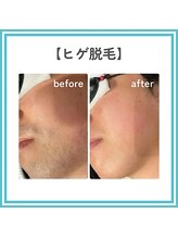 トッコ 那須塩原店(tocco)/ヒゲ脱毛