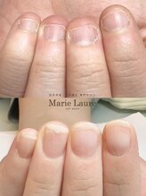 マリーロール 梅田店(Marie Laure)/自爪育成/深爪矯正/ネイルケア