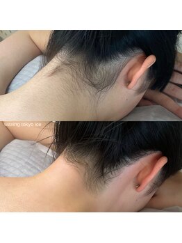 ワクシングトウキョウ アイス 池袋(waxing tokyo ice)/うなじワックス