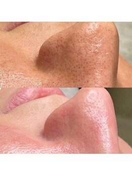 エトレ(ETOLE)/叶える！ちゅる肌☆