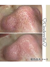 シンデレラ メンズ(Cinderella)/フェイシャル/毛穴洗浄