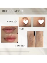 アティロン(Attirant)/【黒ずみ/くすみ改善】