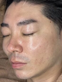 ホワイトアクア 京都店(WHITE AQUA)の写真/メンズのお客様も大歓迎☆セルフケアだけではいきとどかない肌悩みにはプロが根本からアプローチ！