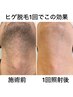 【最新機器★痛みが少ない★都度払い】男性ヒゲ脱毛¥5,000