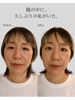 リ バース 立川(RE:birth)/小顔変化　BeforeAfter