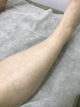 ナノハナ/鹿沼市本格全身脱毛ナノハナ