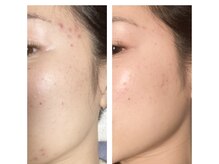 アンテイン チル(anthein chill)/BeforeAfter