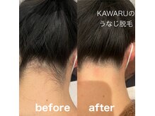 カワル(KAWARU)の雰囲気（大人気うなじ脱毛☆光脱毛#シェービング#うなじ脱毛#メディセル）