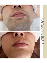 シンデレラ メンズ(Cinderella)/髭脱毛