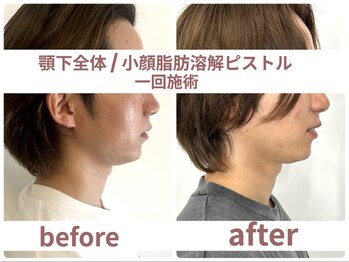 サボラミ(sabor A Mi)/小顔溶解ピストル施術 1.5倍量