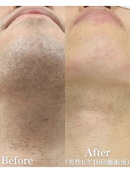 モアビューティ(More Beauty)/ひげ脱毛