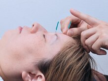 鍼灸整体院ヒビオル【曽根】/美容鍼（初めての方）♪