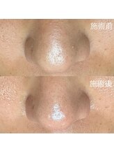 エクラ バイ シャンリィ(eclat by shanLy)/毛穴ケア