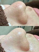 エクラ バイ シャンリィ(eclat by shanLy)/毛穴詰まり解消