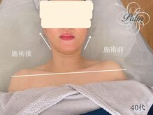 パーム(Palm)/たるみは首肩から緩和