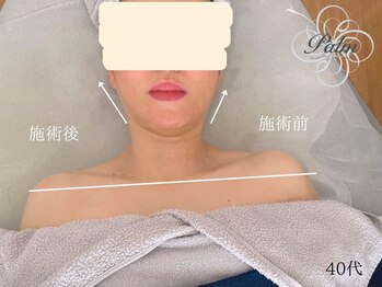 パーム(Palm)/たるみは首肩から緩和