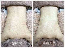 シェミー(CHEZ MEE)/【美ボディ】背中の引き締め