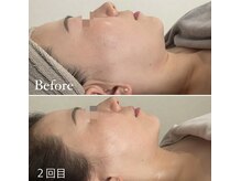 コルギ デ コガオ(KORUGI de KOGAO)/UDM超小顔リフティング