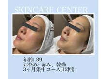 アンジェラックス スキンケアセンター 渋谷/赤み、敏感なお客様の改善症例