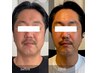 【募集中・モニター様】針を使わない脂肪分解（圧倒的小顔・二の腕）