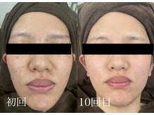 チャマ 高知店(CHAMA)/20代　ララピール　ニキビ改善