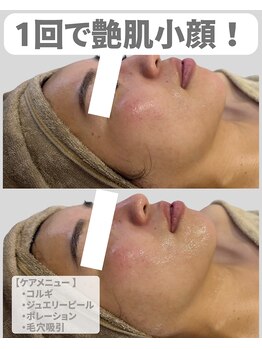 アディス 心斎橋(ADISE)/1回で艶肌小顔！