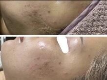 ルビー(Ruby)の雰囲気（【20代後半】ハーブピーリング1回・頬のニキビ悩み）