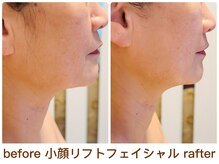 ルル リラクゼーション(RURU Relaxation)/小顔リフト/フェイライン