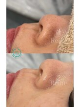 レーヌ(Reine)/毛穴エクストラクション