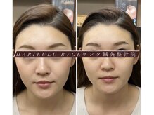 ハリルル 併設 GLケンタ鍼灸整骨院(HARILULU)/ハイパーナイフ×美容鍼　