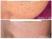 フォーチューン/シミの改善ケア経過お写真