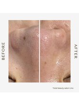 リノ(Lino)/BeforeAfter