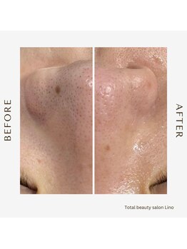 リノ(Lino)/BeforeAfter