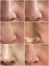 マヴィ 守口店(MavY.)/毛穴は変われる！