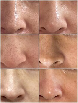 マヴィ 守口店(MavY.)/毛穴は変われる！